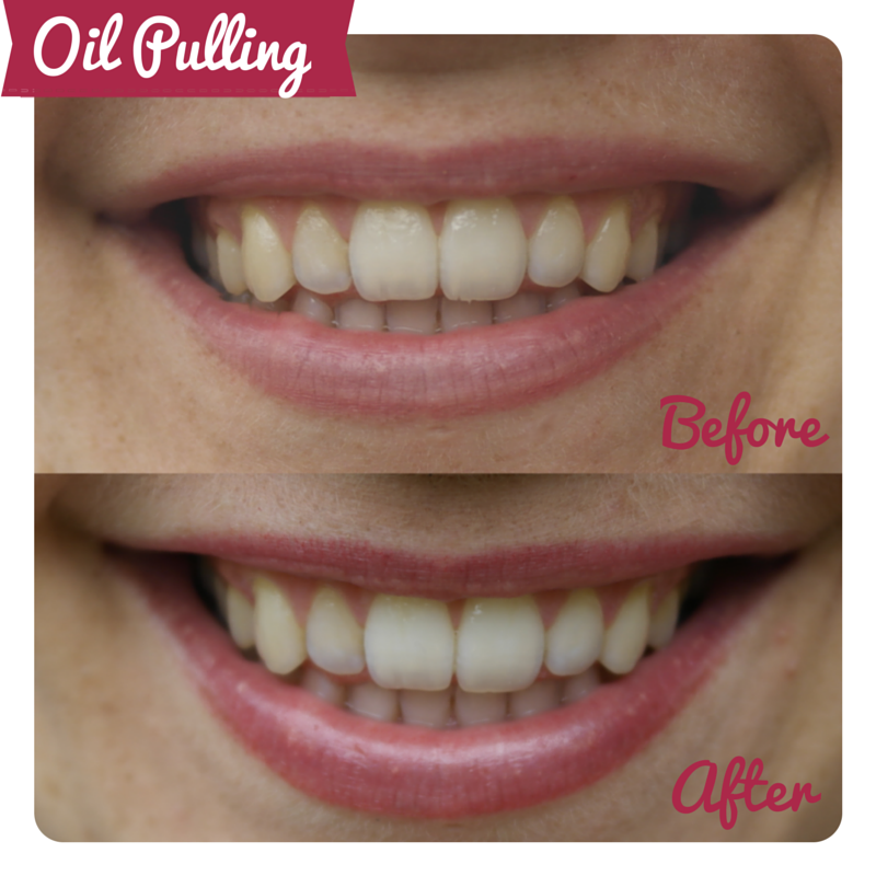 OIL PULLING BEFORE AND AFTER OIL PULLING BEFORE AND AFTER