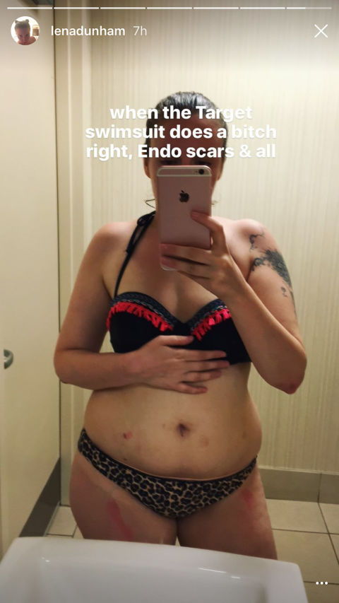 Lena Dunham shares pictures of her endometriosis scars